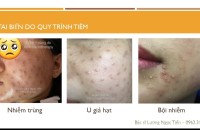 Xử Lý Tai Biến Khi Tiêm Meso