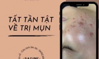 MỤN - THẤU HIỂU TRƯỚC - ĐIỀU TRỊ SAU